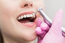 clinica-dental-jerez-servicio-blanqueamiento-2