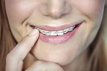 clinica-dental-jerez-servicio-brackets