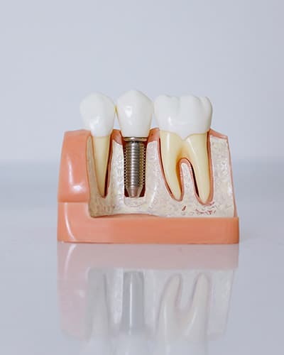 implantes-dentales-jerez-modelo-de-implante