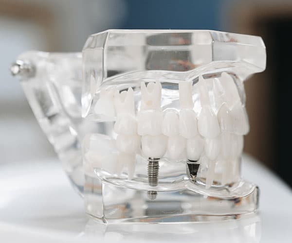 implantes-dentales-jerez-molde-en-acrilico
