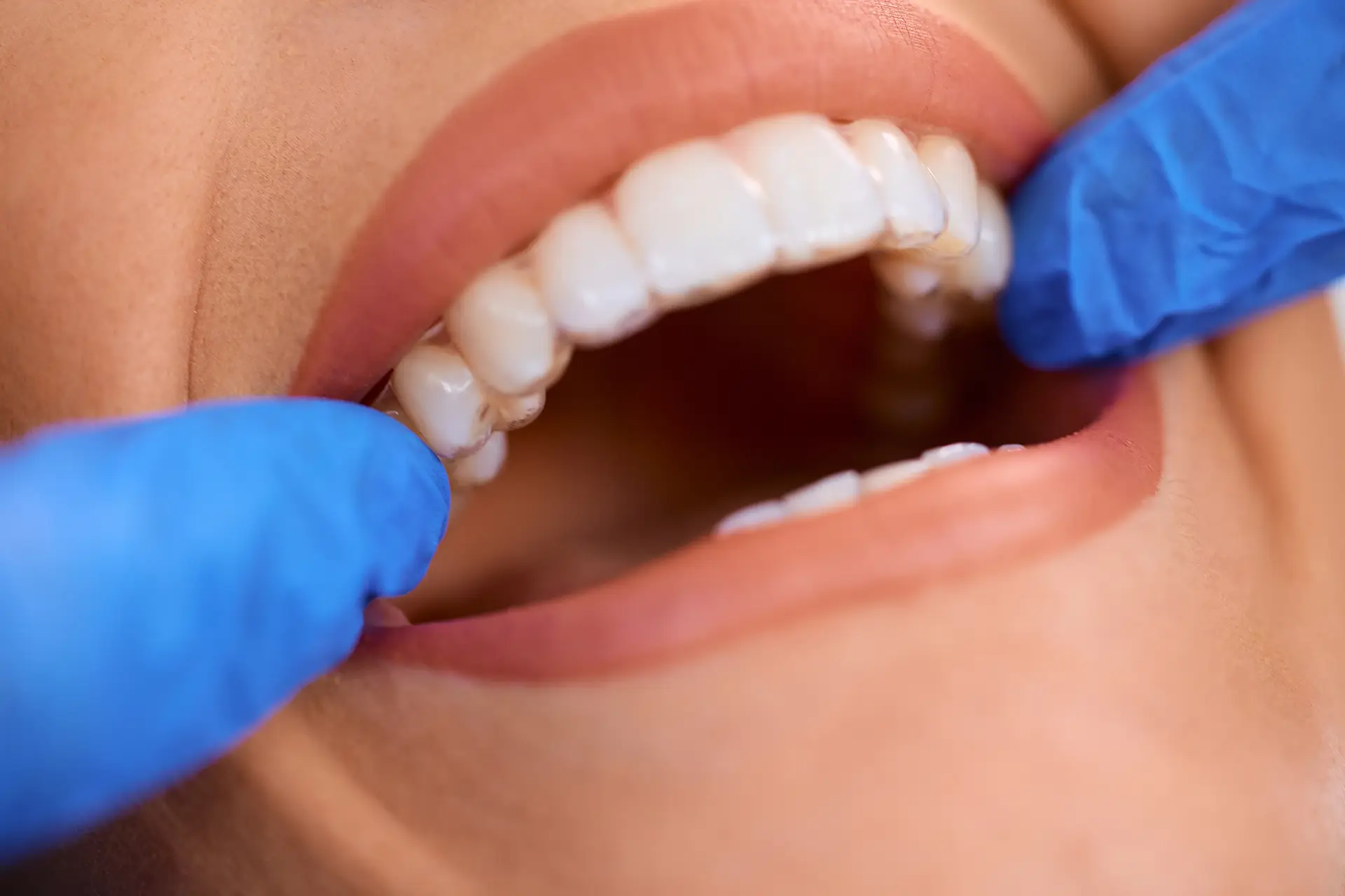 beneficios de la ortodoncia invsible