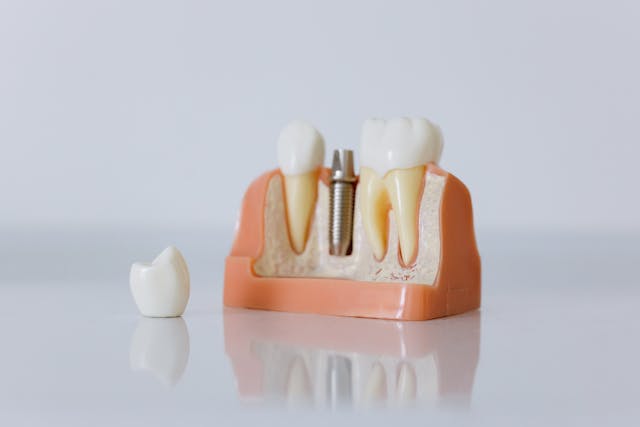 me duele mucho el implante dental